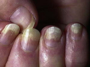Tratament cu ciuperca unghiilor verzi